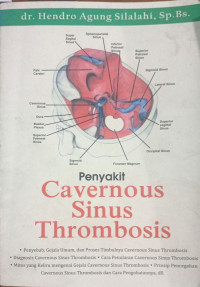 Image of Penyakit Cavernous Sinus Thrombosis